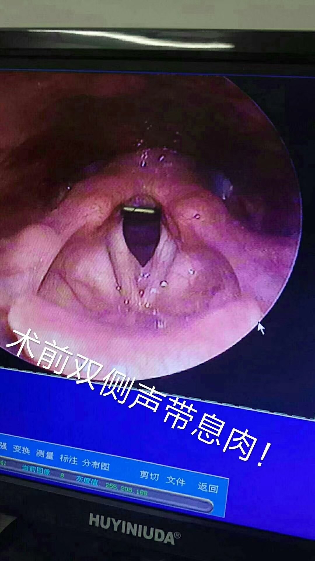 喉镜下看到的鱼刺