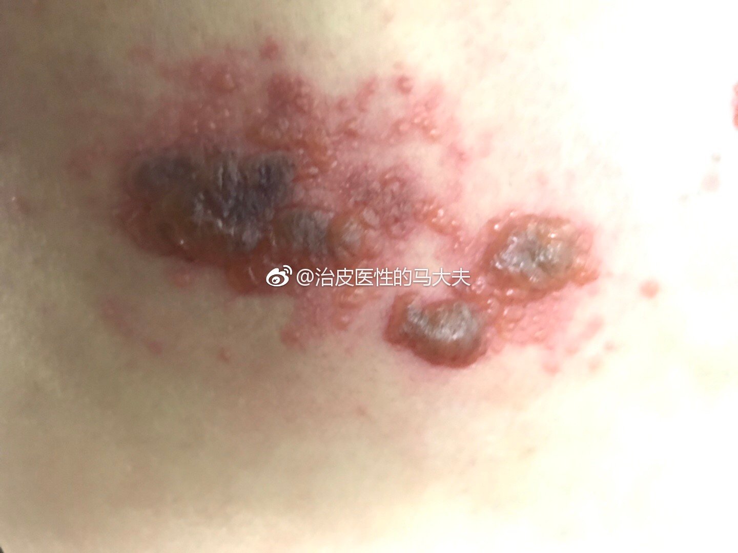 马尊峰 文章列表 生殖器疱疹是一种慢性,终身性的病毒感染.