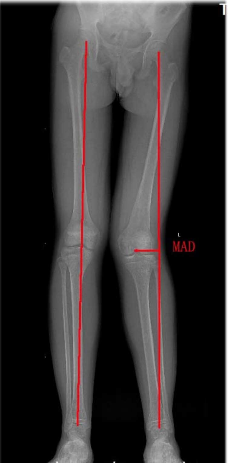 mldfa和mpta正常值85-90角,如mldfa小于85度则考虑股骨远端外翻畸形