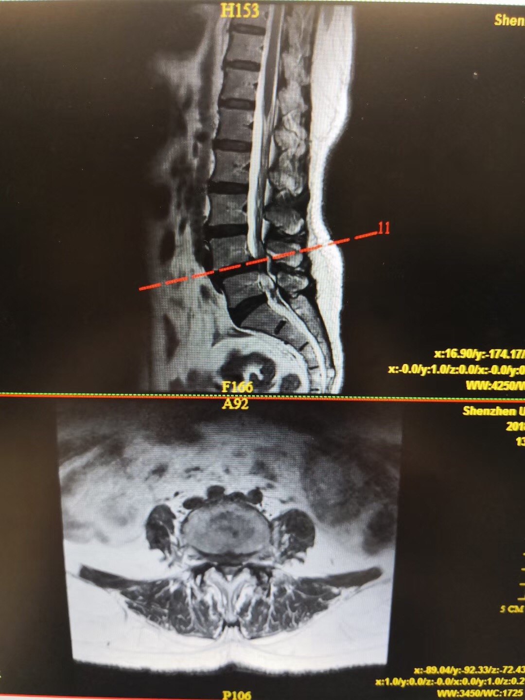 腰椎体滑脱手术案例你不必忍痛跛行十几年