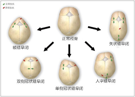 孩子头型不好看千万要当心狭颅症