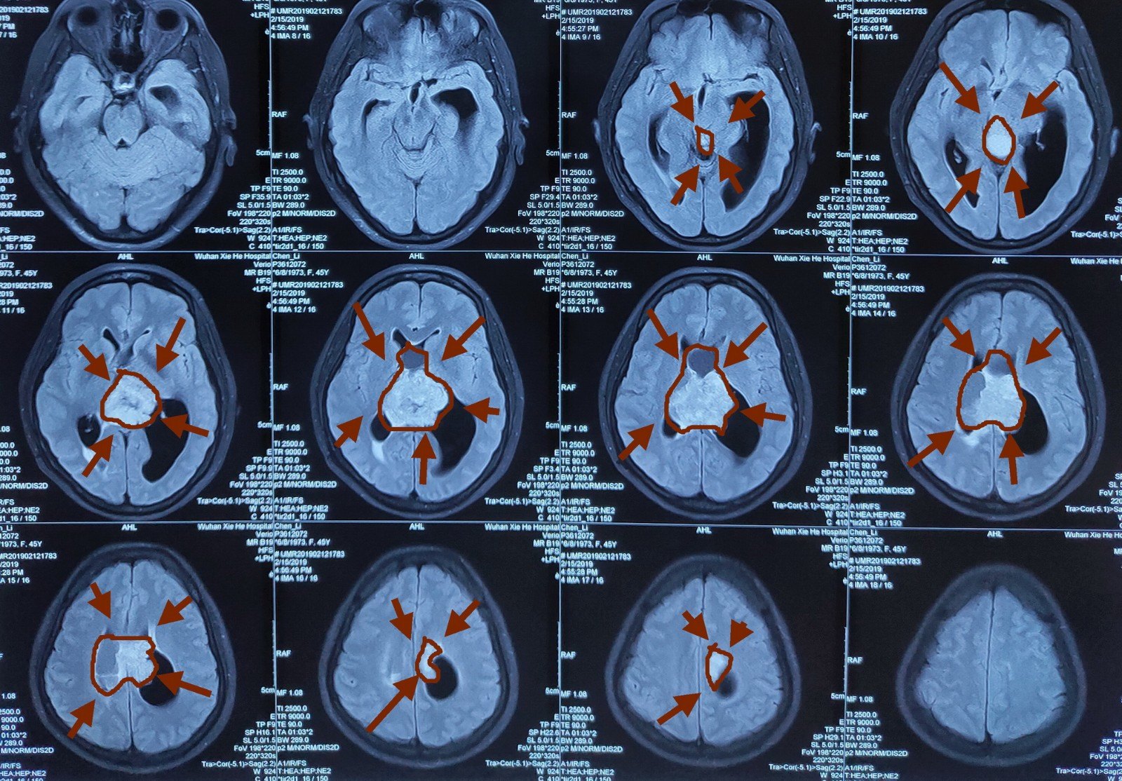 跨中线巨大脑室肿瘤-中枢神经细胞瘤,一种极为少见的