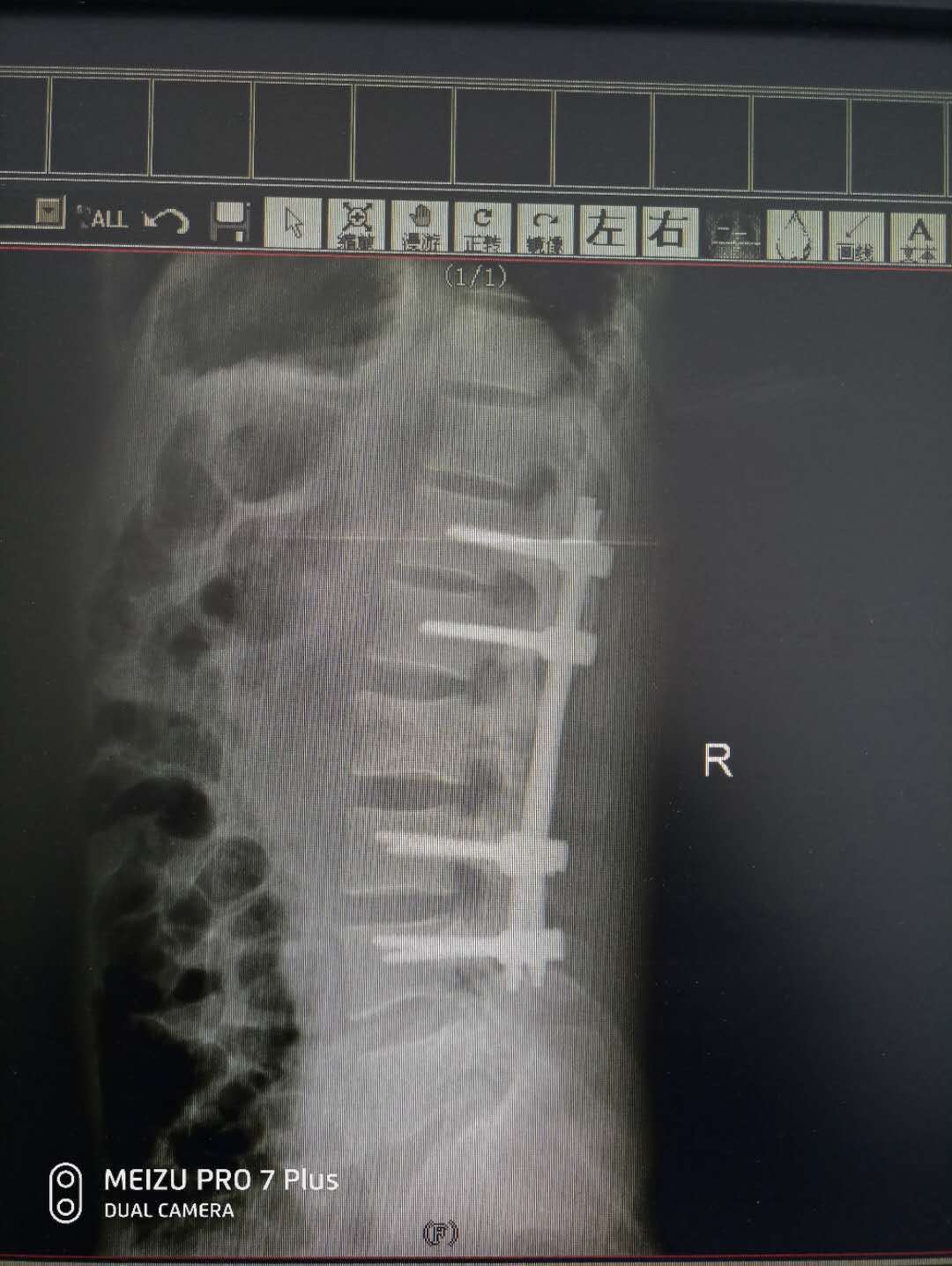 高处后隐匿性的脊柱chance骨折介绍