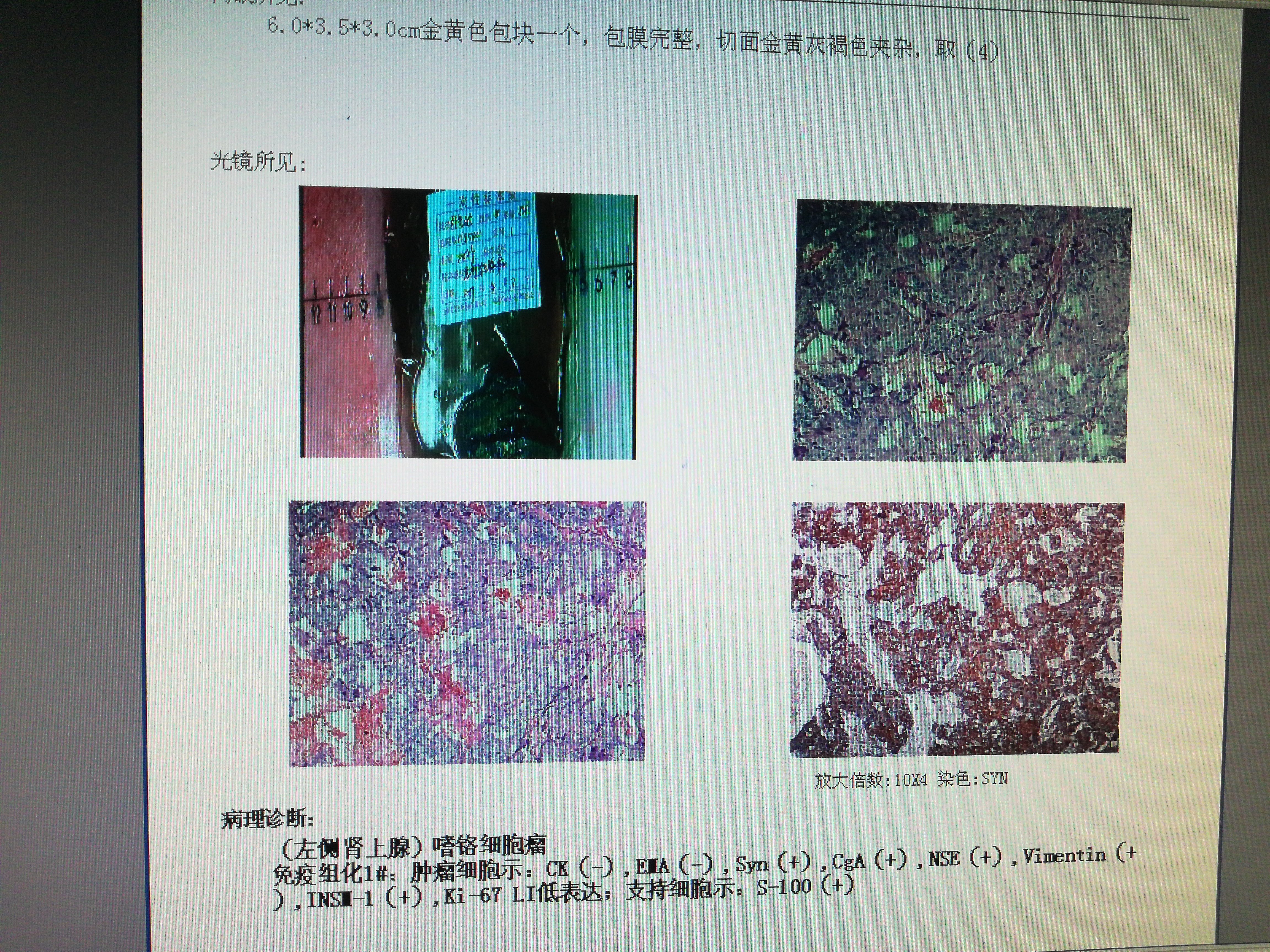 腹腔镜巨大肾上腺肿瘤嗜咯细胞瘤切除术1例