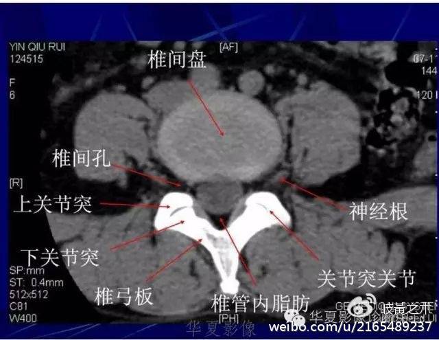 腰椎间盘突出症的病因及致病原理