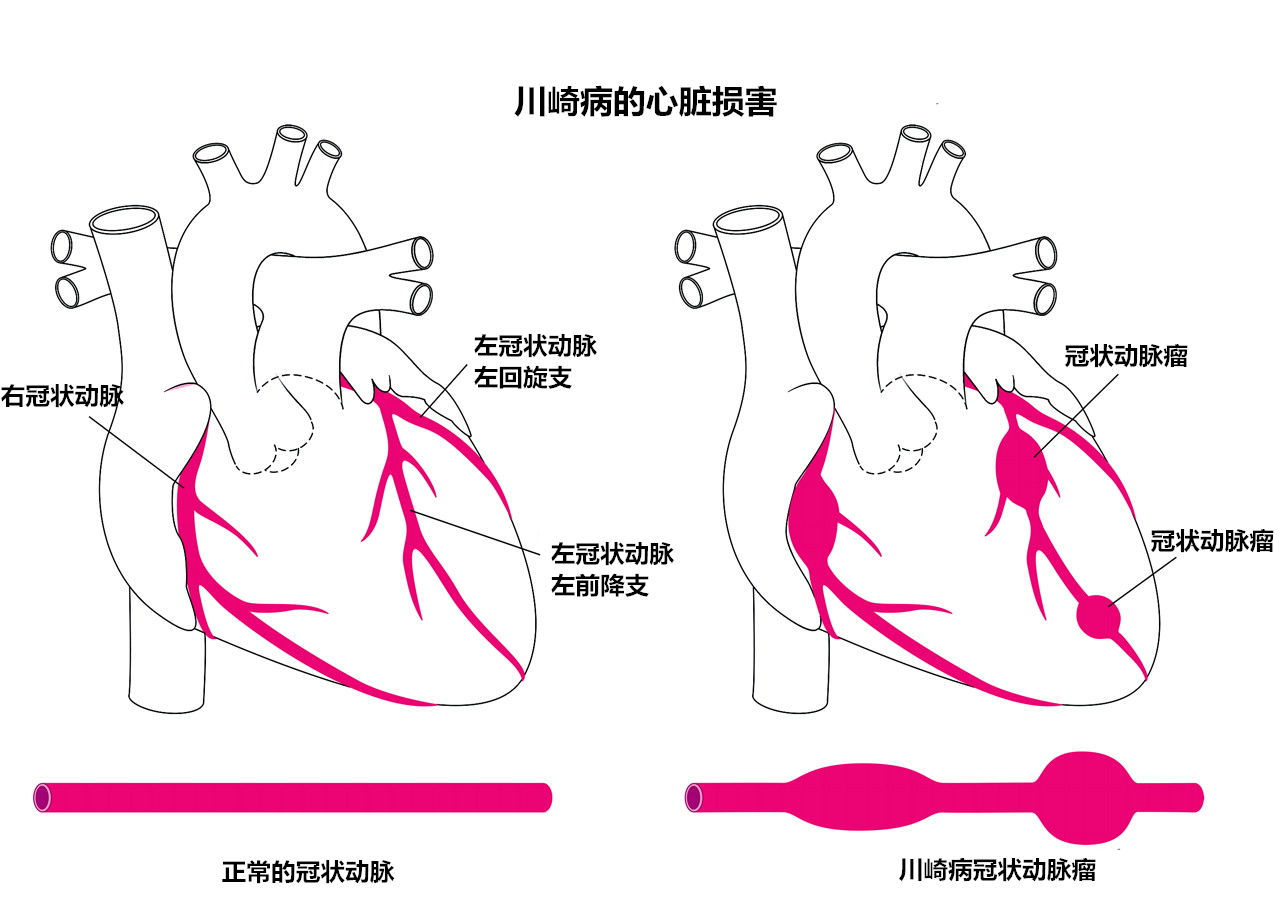 川崎病-儿童特殊而又凶险的"冠心病"