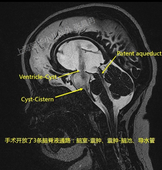 鞍上池蛛网膜囊肿的微创治疗