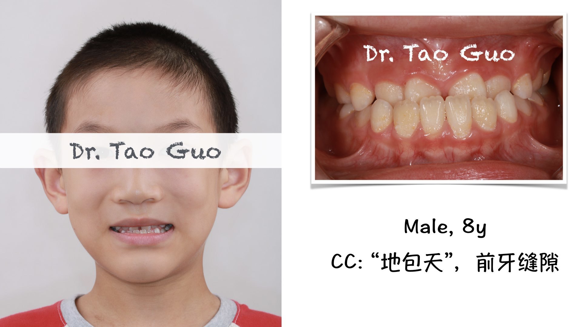 郭涛 文章列表  " 地包天 "是指下前牙盖住了上前牙,与正常上牙盖下牙