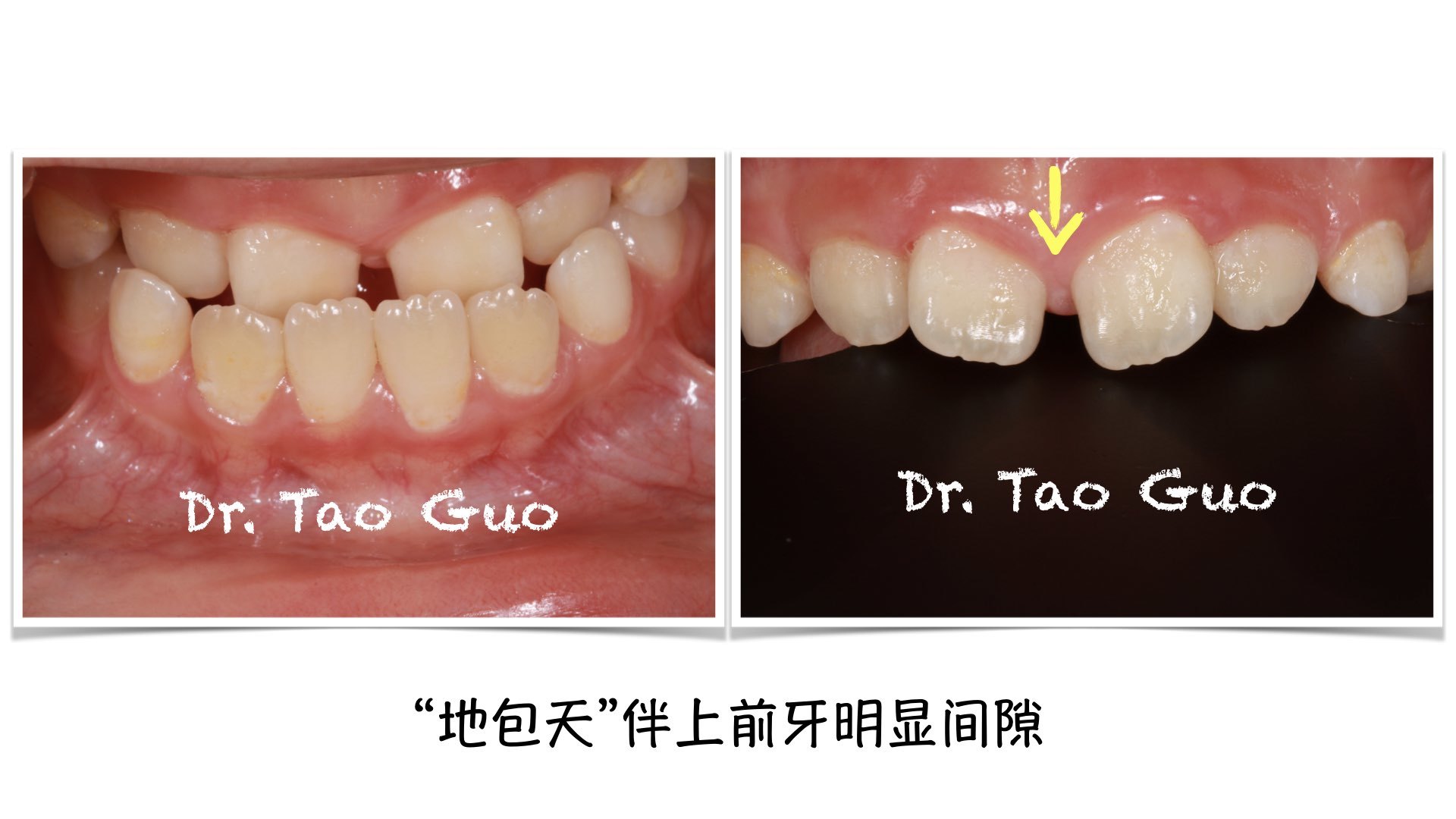 儿童地包天矫正案例