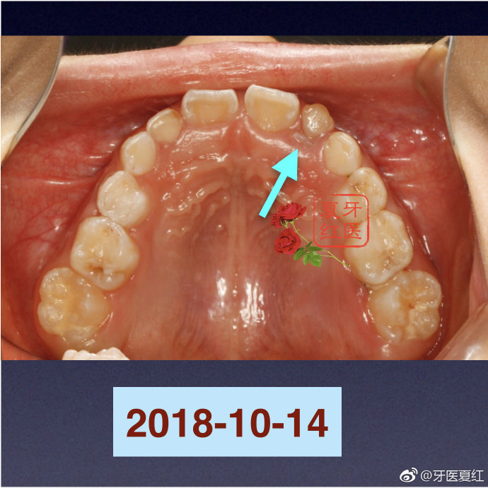 【换牙期间出现了双排牙该怎么办?】