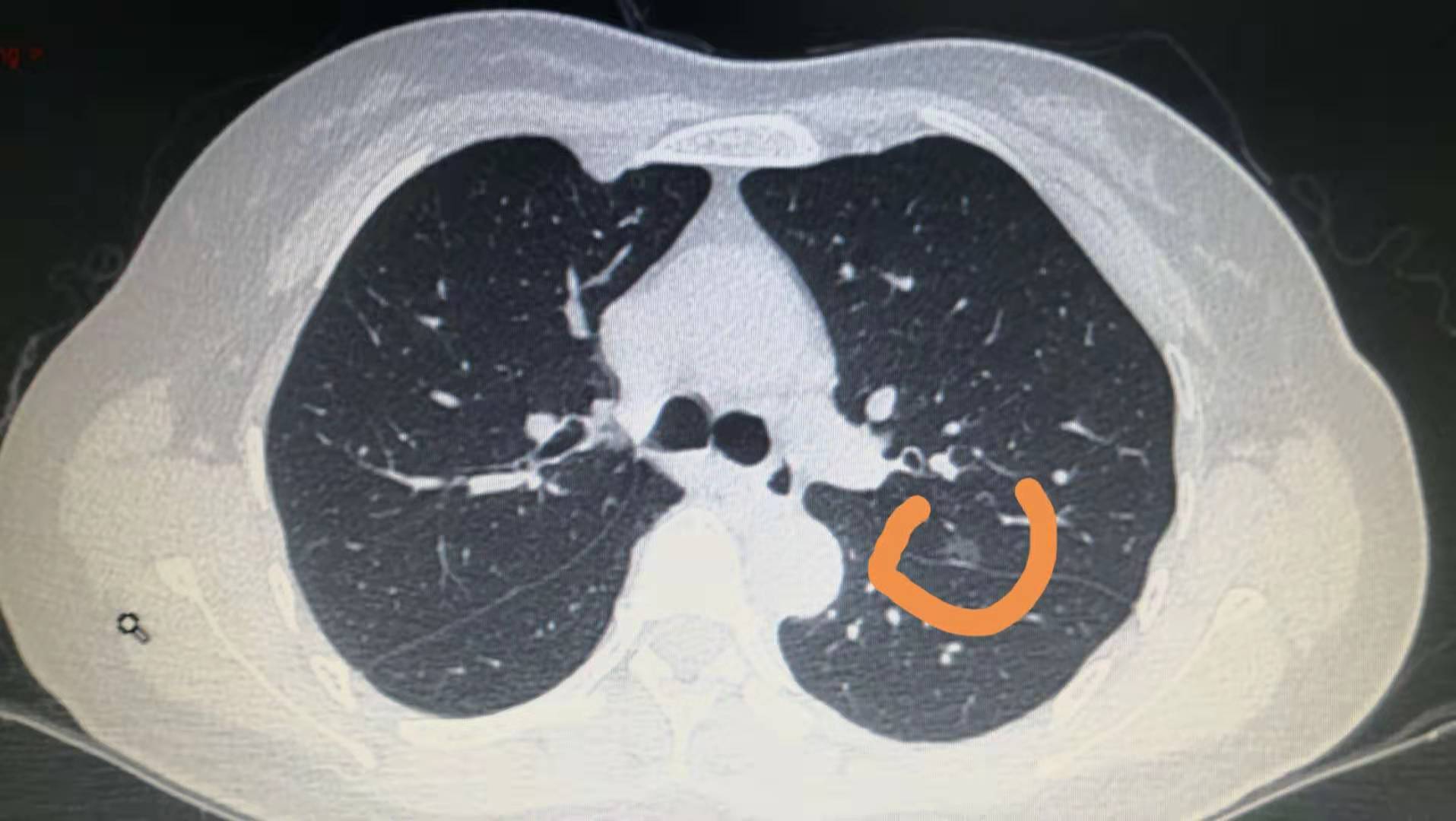 成功解决肺小结节治疗难题精准切除快速康复出院