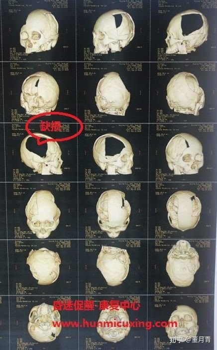 图2:来到我们昏迷促醒中心后我们给病人检查的头颅ct三维重建,为