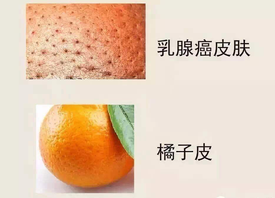 (2)"橘皮症",是肿瘤细胞堵塞皮下毛细淋巴管网,形成皮肤水肿,而毛囊处