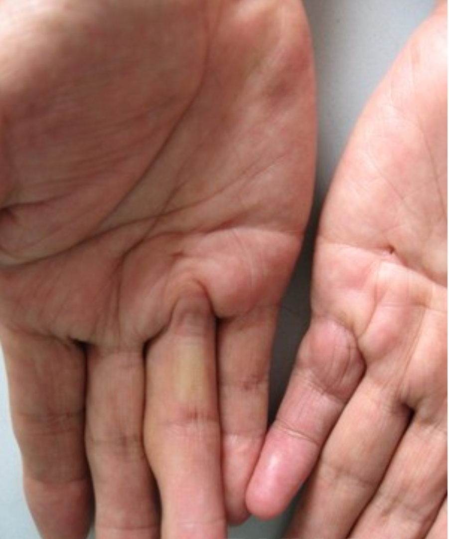 手指屈曲伸不直,原来是这个病掌腱膜挛缩症