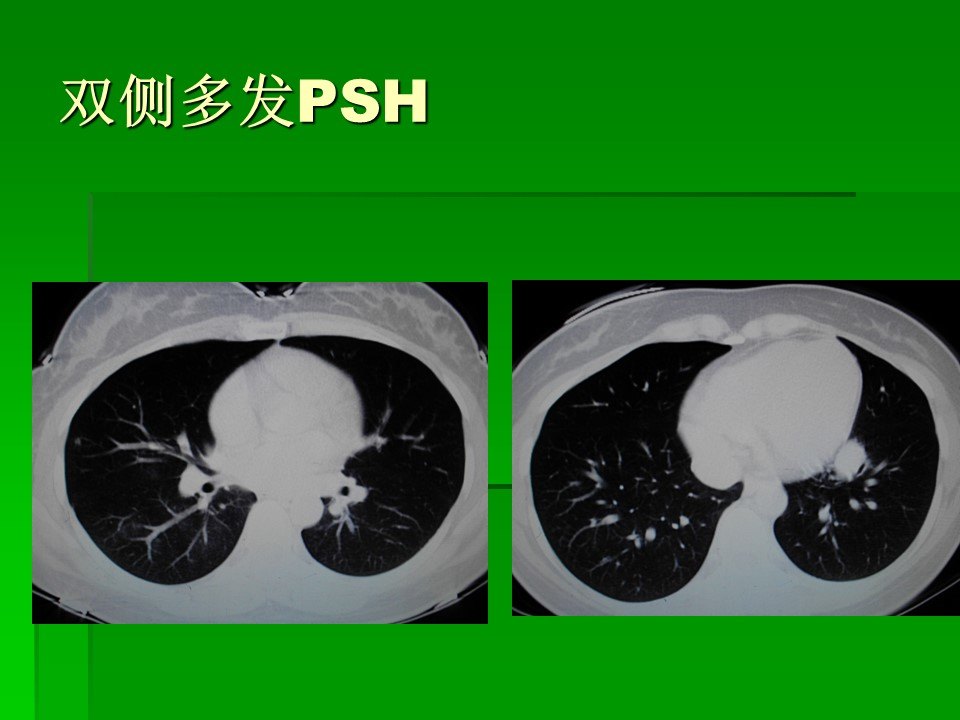 硬化性 血管瘤 作为良性 肿瘤 ,一般术后预后比较好,不会发生转移复发