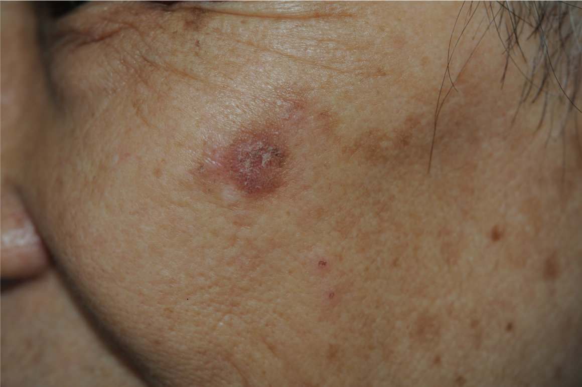 鳞状细胞癌早期会表现为皮肤上,尤其是日光暴露部位的红斑,斑块,表面