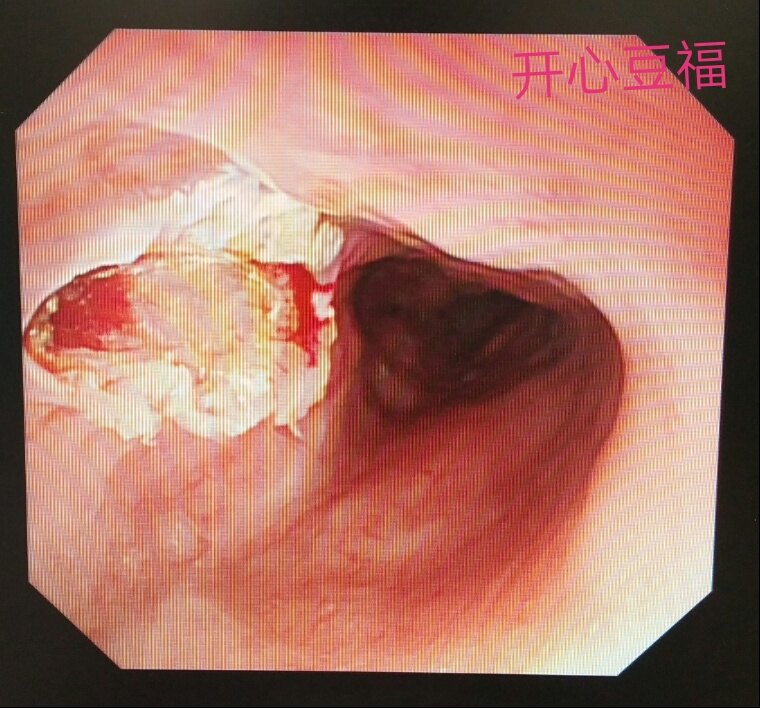 食管平滑肌瘤介绍和治疗_食管良性肿瘤