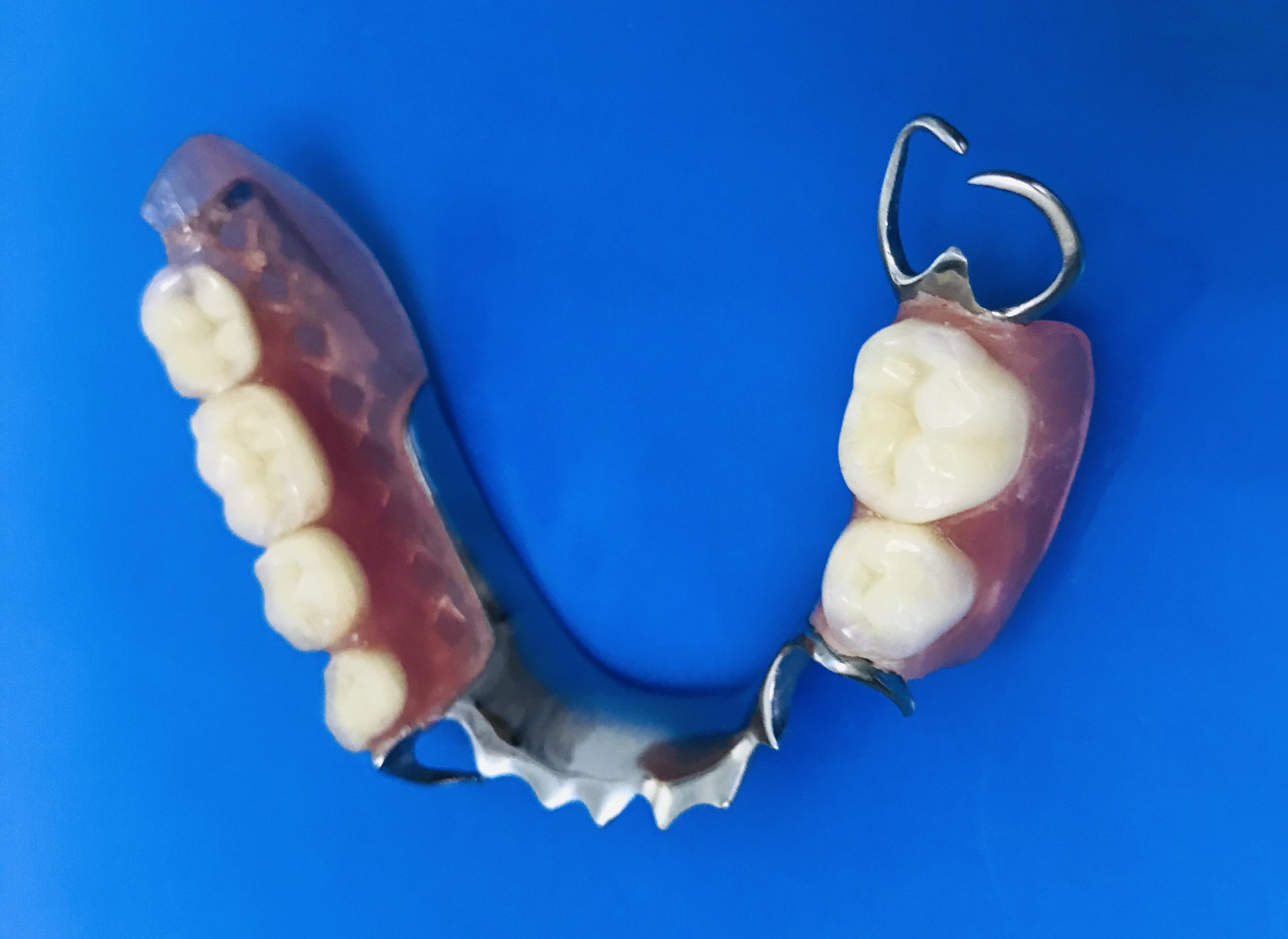 义齿  活动修复是通过金属或塑料卡环,固定在旁边天然牙齿上或直接扣
