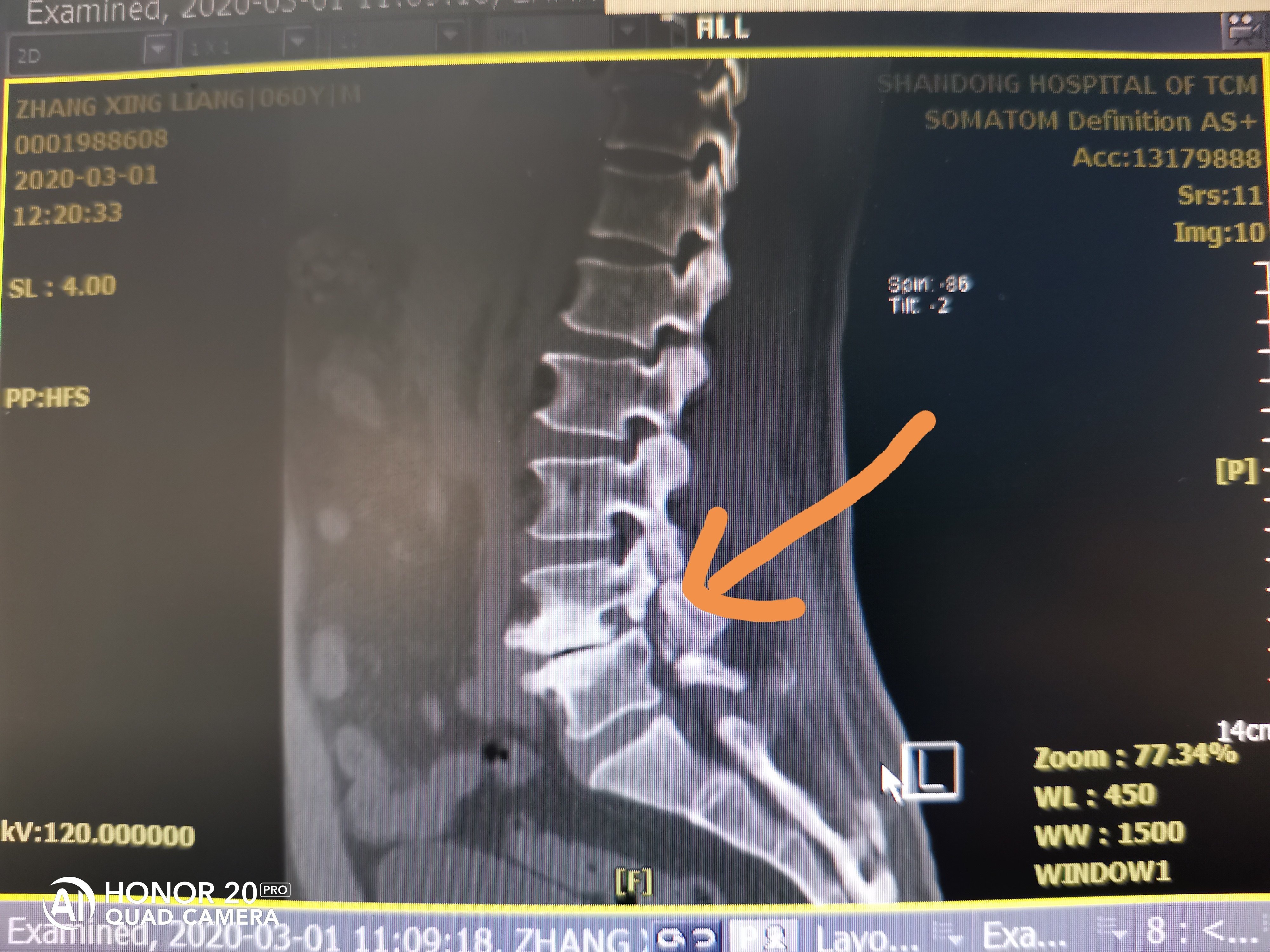 今日分享:一位患者,60岁,腰椎滑脱1度,l4,l5椎体双侧椎弓根崩裂