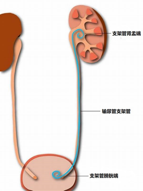 2. 因为疫情,不能返院拔输尿管支架管怎么办?