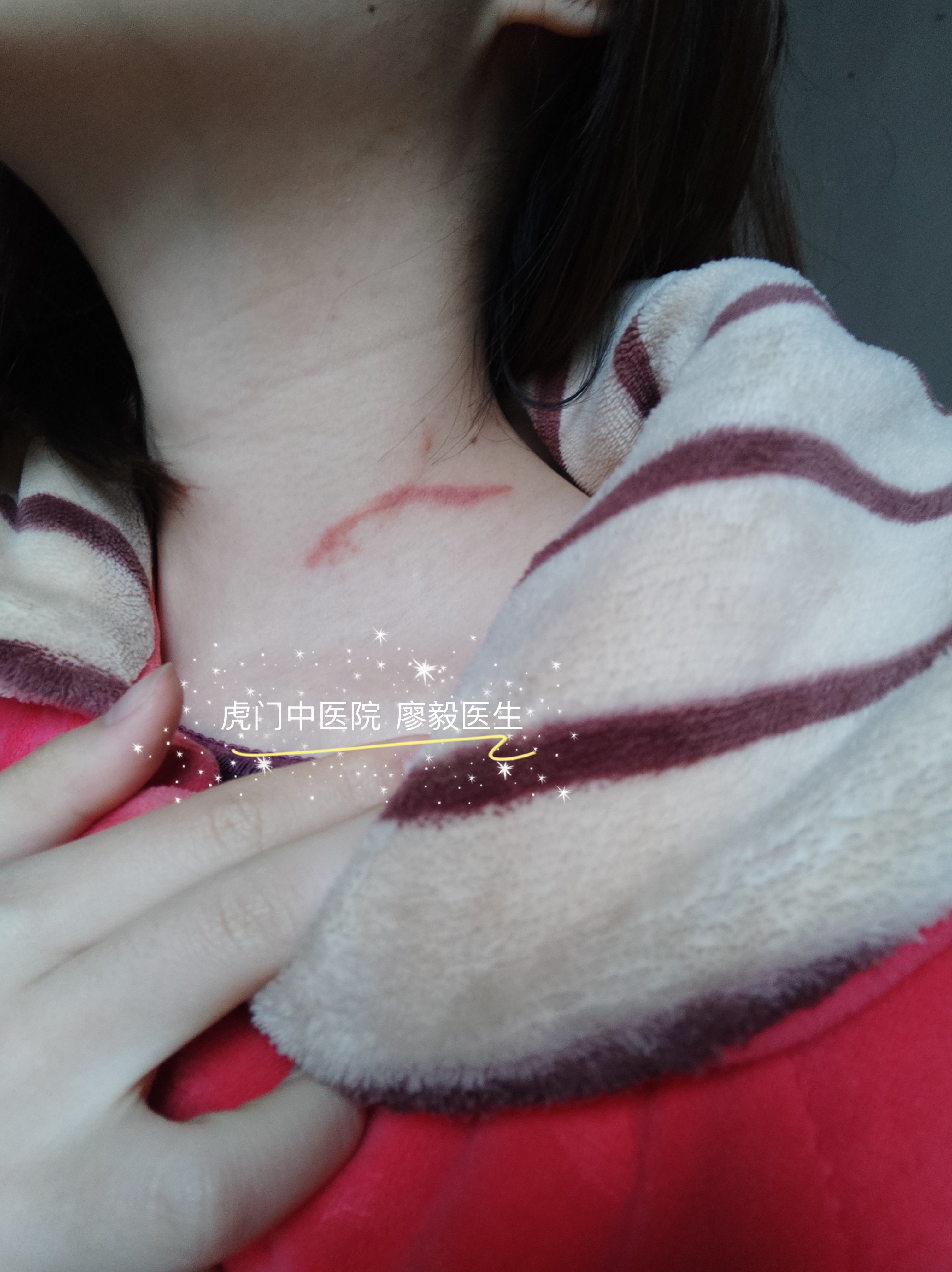 隐翅虫皮炎是什么?