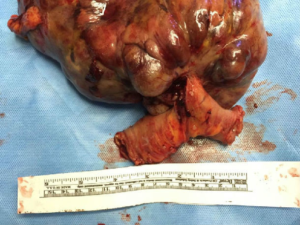 腹部巨大小肠间质瘤一例! 