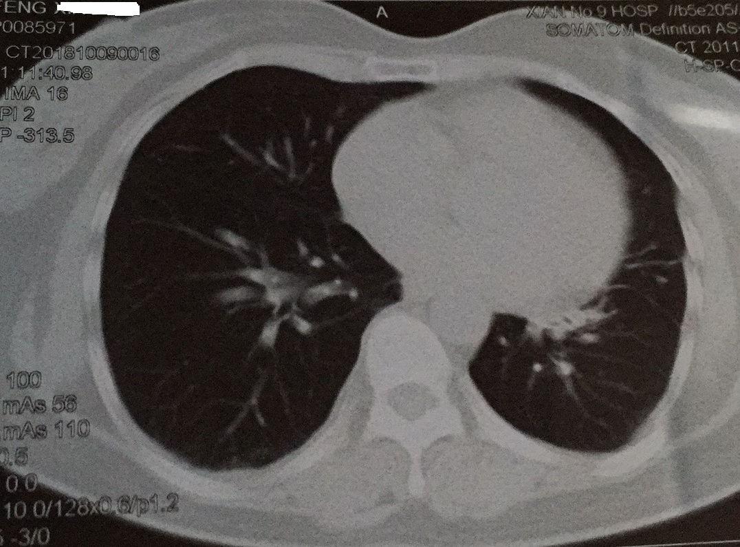 冯大姐的肺部肿块消失了 虚惊一场的肺癌