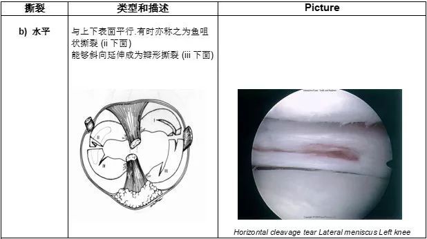 收肌腱裂孔图片