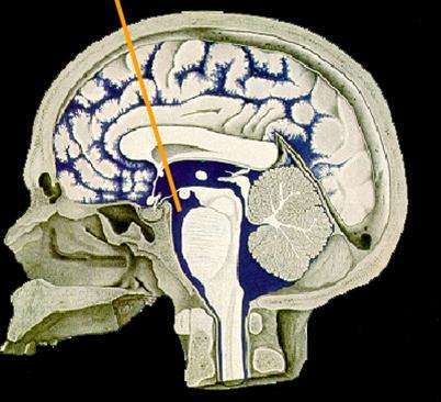 大脑第三脑室图片图片