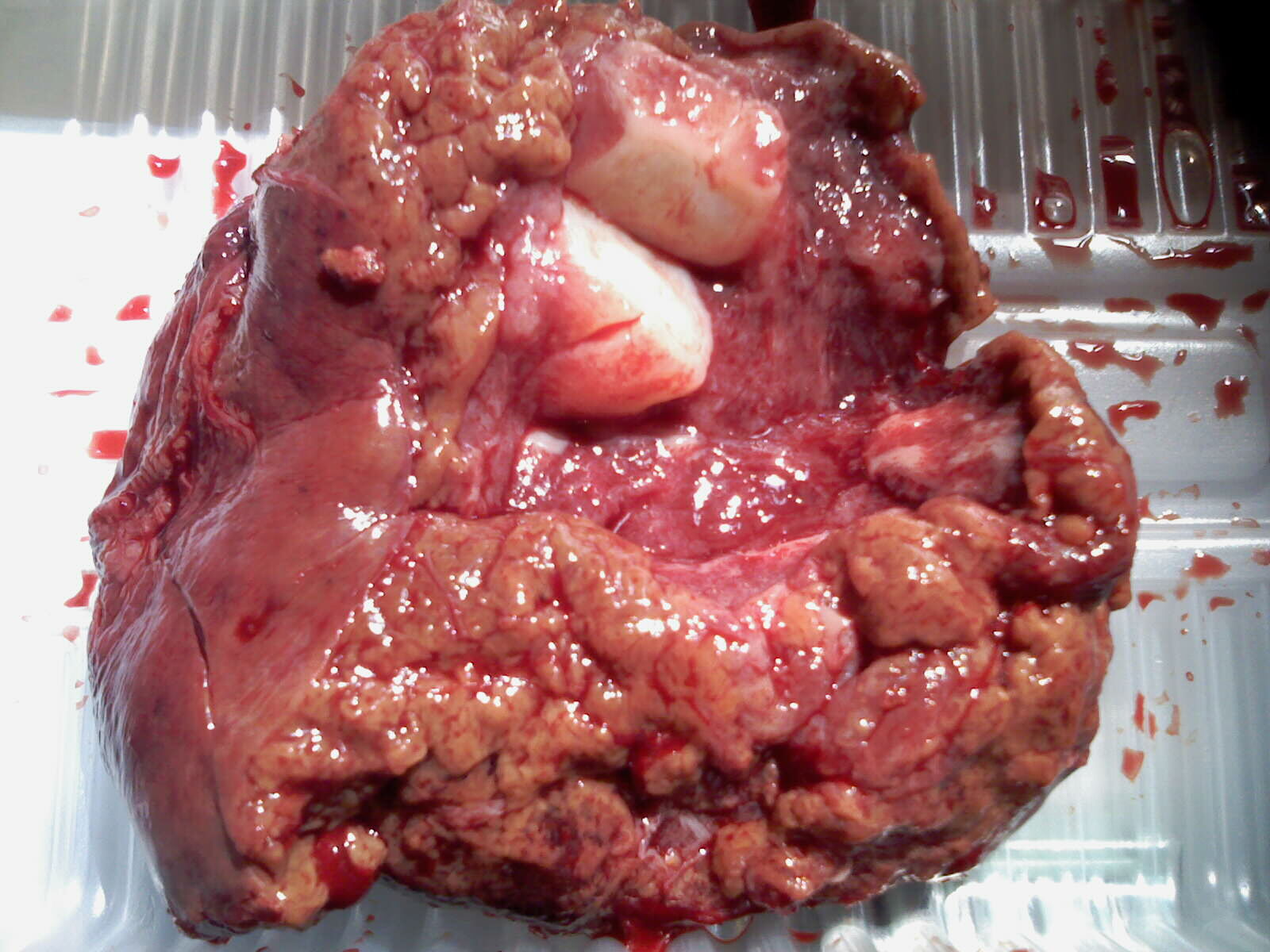 肝血管瘤ct及切除标本!注意与肝癌区别! - 好大夫在线