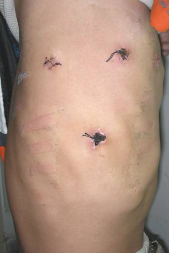 胸部微创手术伤口图片