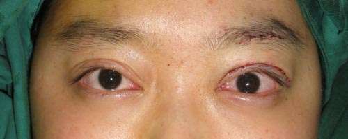 面瘫修复眶距增宽矫形上睑下垂修复鼻翼缺损畸形应用整形外科原则修复