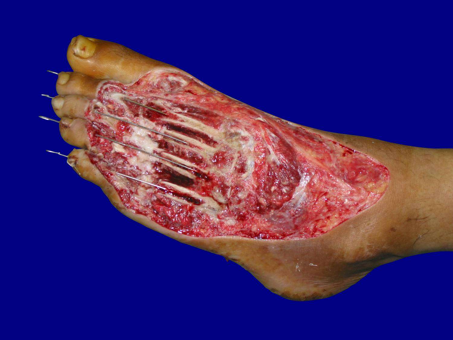 小腿足踝部皮肤缺损创面的修复