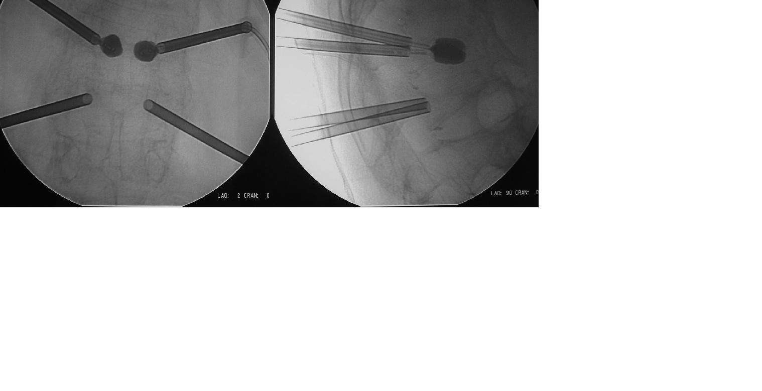 球囊扩张椎体后凸成形术 - 好大夫在线