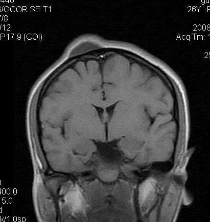 颅骨骨膜窦:术中所见颅骨多发筛孔,可见异常血管团ct表现为颅板外头皮
