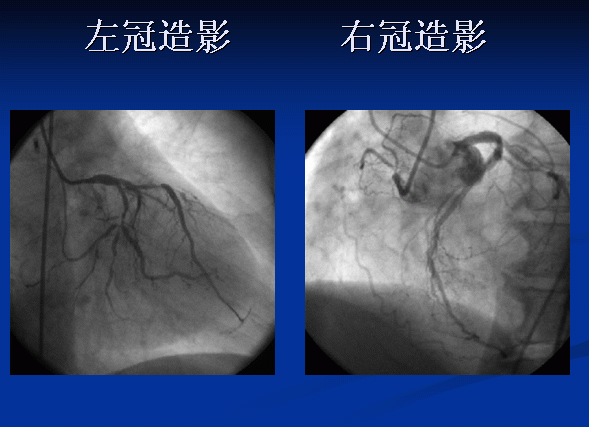 左主干,前降支 pci和右冠脉cto pci(逆向技术)之一 - 好大夫在线