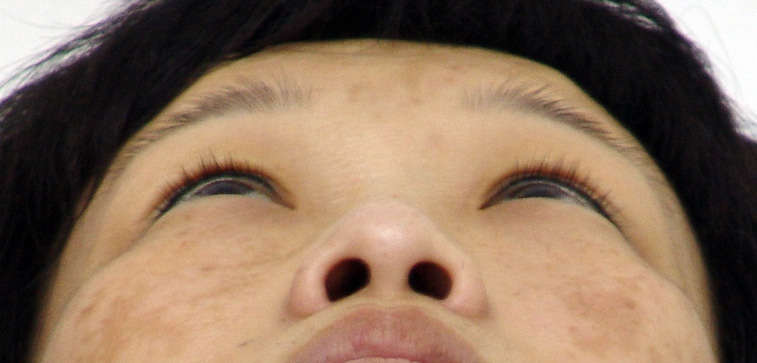 给鼻子"收腰"--宽鼻背缩窄术---薛志强医生手术作品 - 好大夫在线