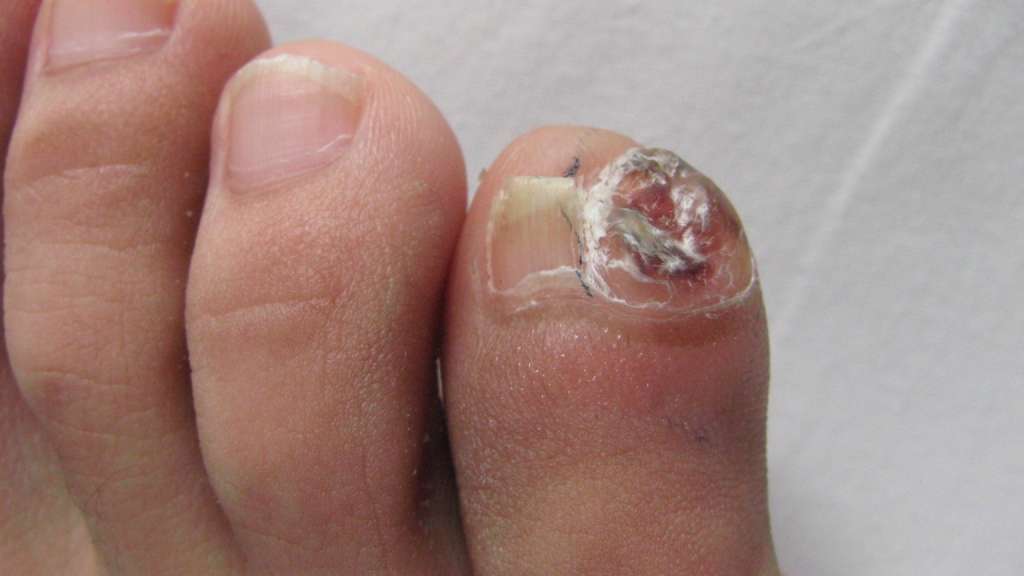 第五趾骨末节骨疣