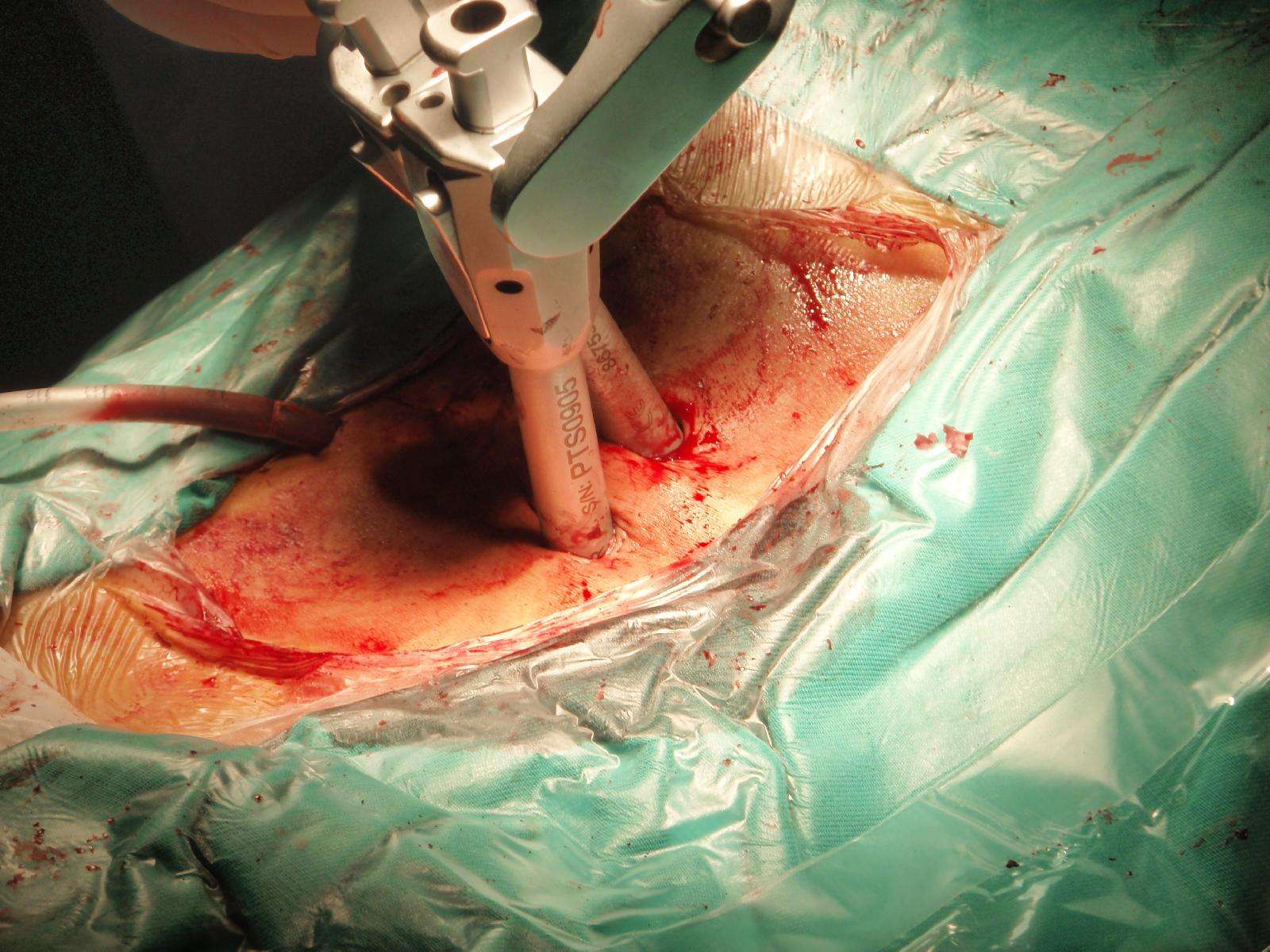 椎间盘镜下减压 经皮椎弓根螺钉内固定 - 好大夫在线