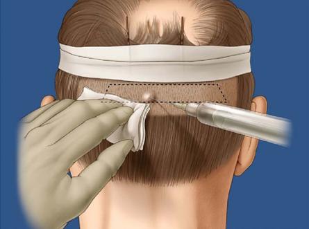 hair transplantation. - 好大夫在线