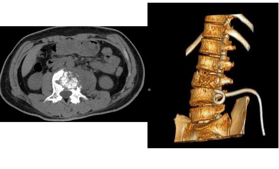 脊柱结核病例1:腰椎结核前路病灶清除植骨内固定术 - 好大夫在线