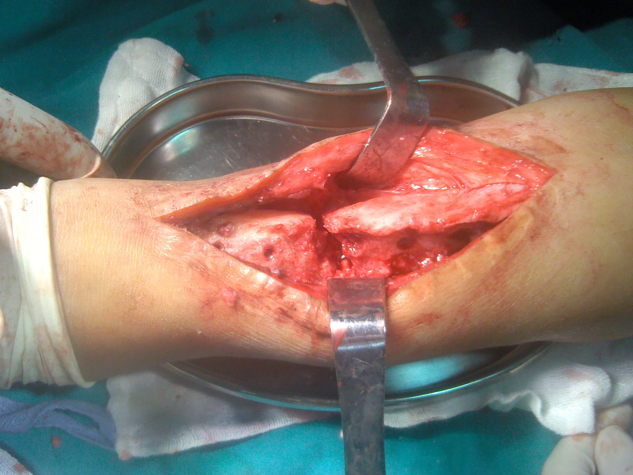 感染性骨不连 - 好大夫在线