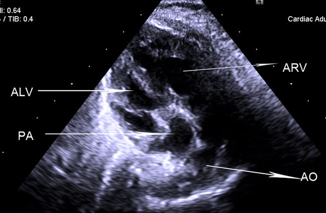arv:解剖学右室)解剖学右室,肺动脉发自于解剖学左室图5生后超声心动