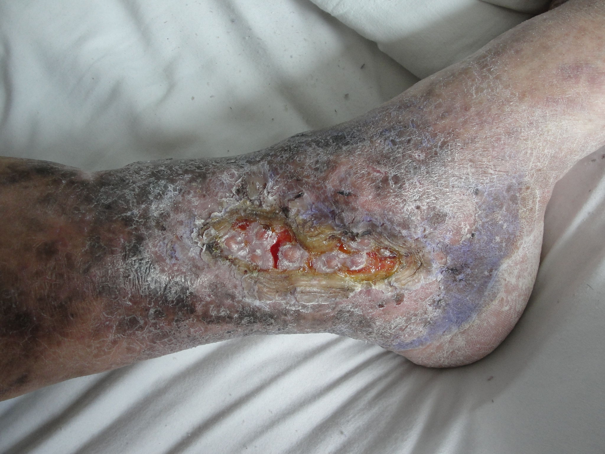 综合治疗下肢慢性顽固性溃疡 - 好大夫在线