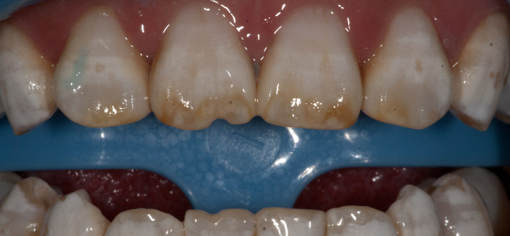 氟斑牙冷光美白一例 - 好大夫在线