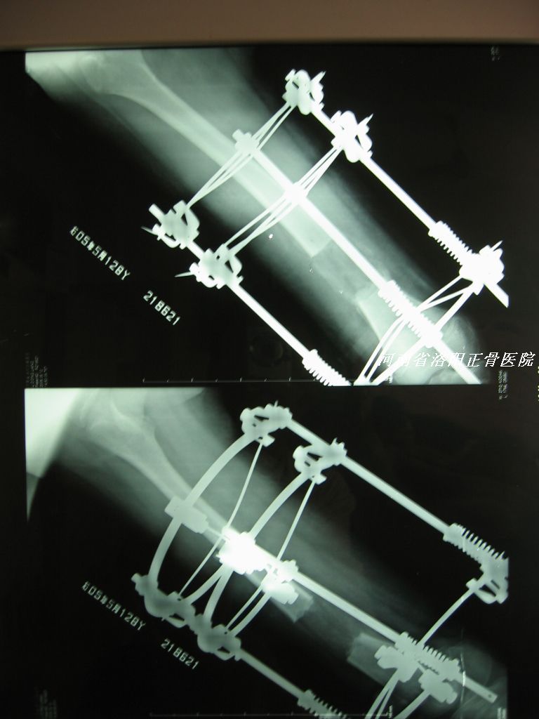 长短腿截骨手术图片图片