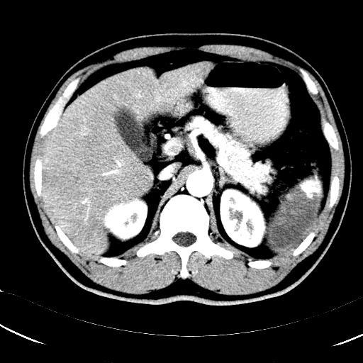 脾梗死_脾切除手术_脾切除手术检查 - 好大夫在线