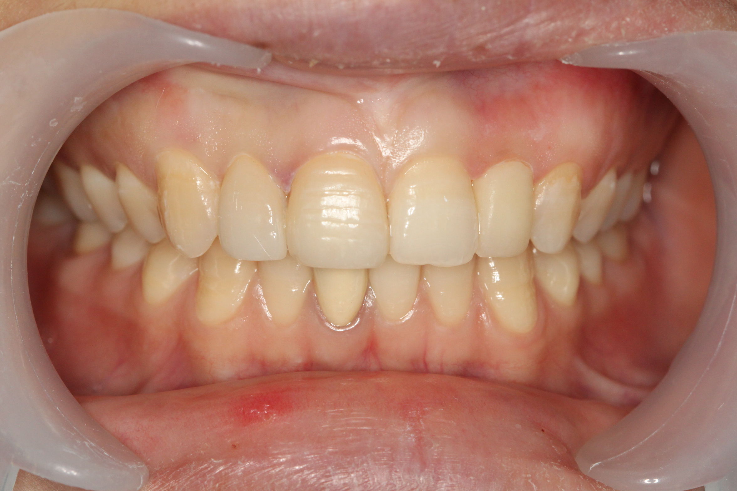 病例三:复杂前牙修复
