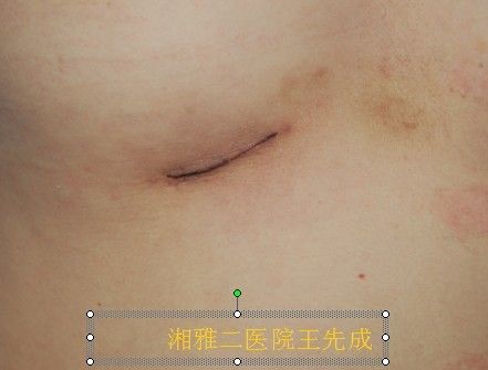 本文仅供健康科普使用,不能做为诊断,治疗的依据,请谨慎参阅