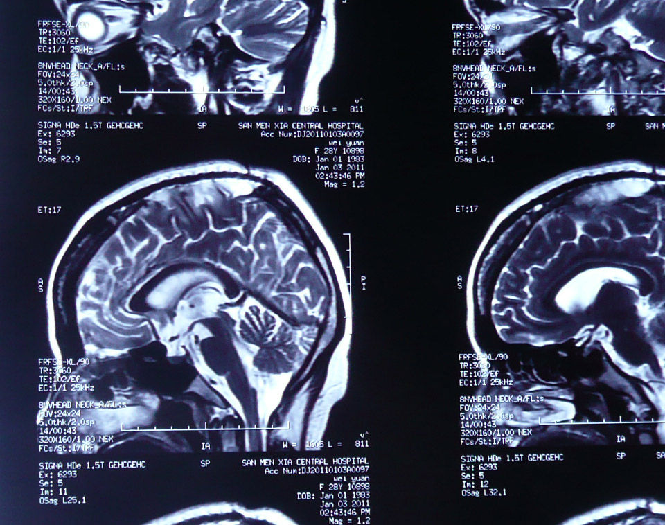 西京医院神经外科颅咽管瘤的手术治疗(实例)